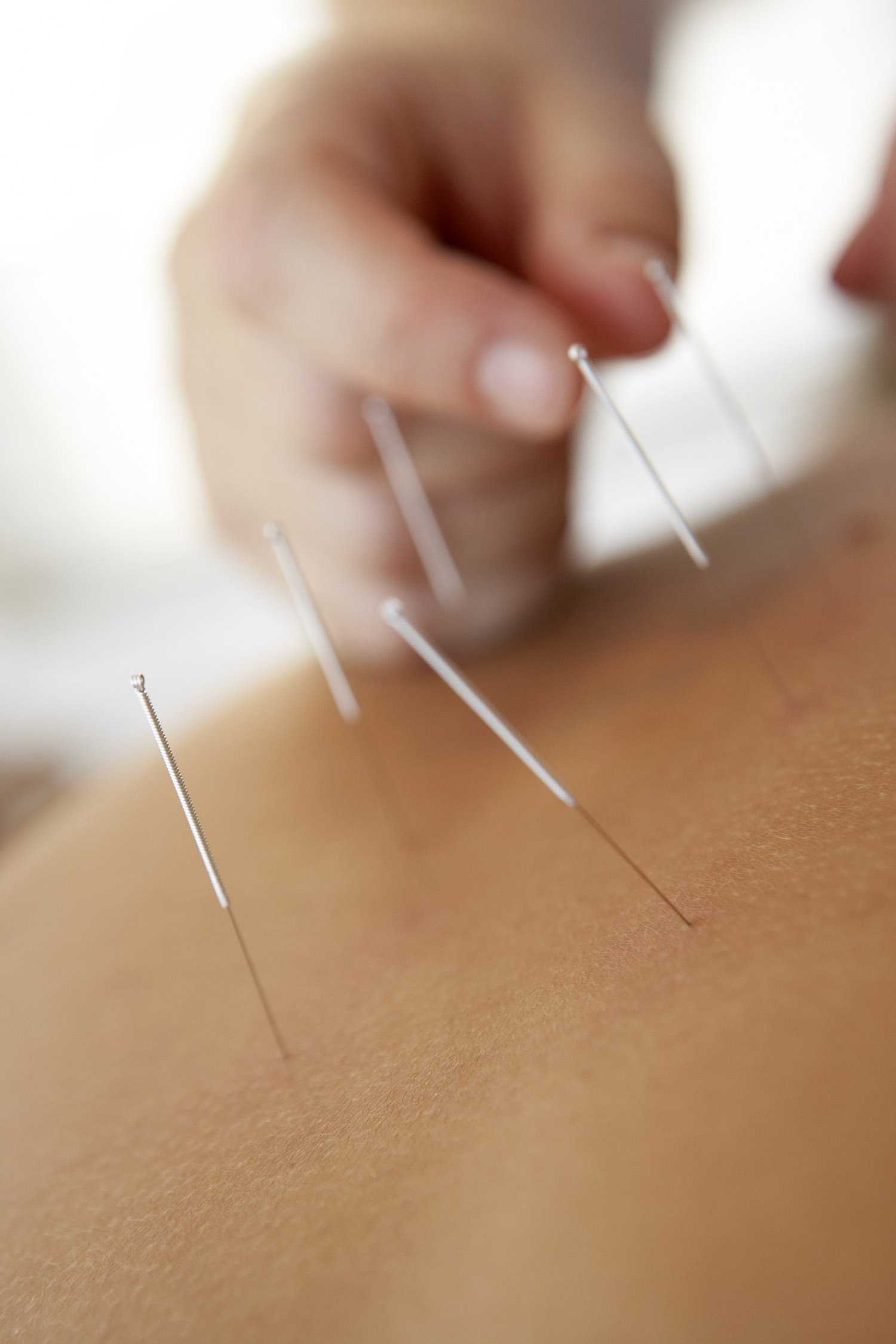 Practitioner applies acupuncture needles to a patient's shoulder.