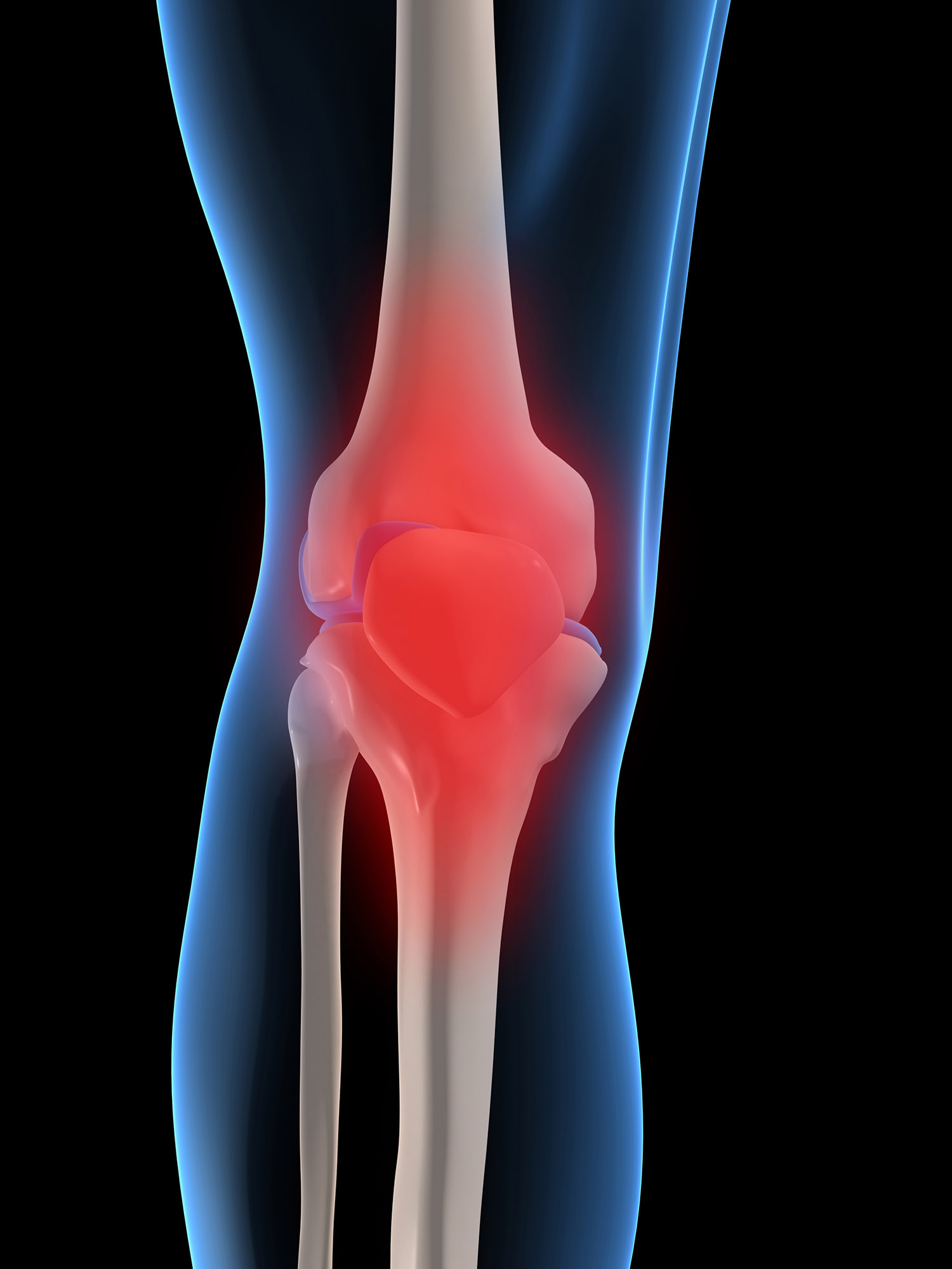 Illustratoin of a leg at the knee, the joining of the bones is red to imply pain. 