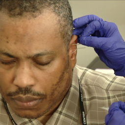 ear acupuncture