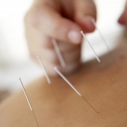 Practitioner applies acupuncture needles to a patient's shoulder.