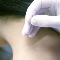 An acupuncture needle applied to a neck location
