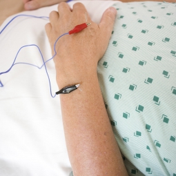 Electroacupuncture needles in arm.