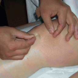 Acupuncture on a knee