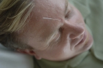 An acupuncture needle in a man's forehead.