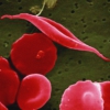 sickle cell 